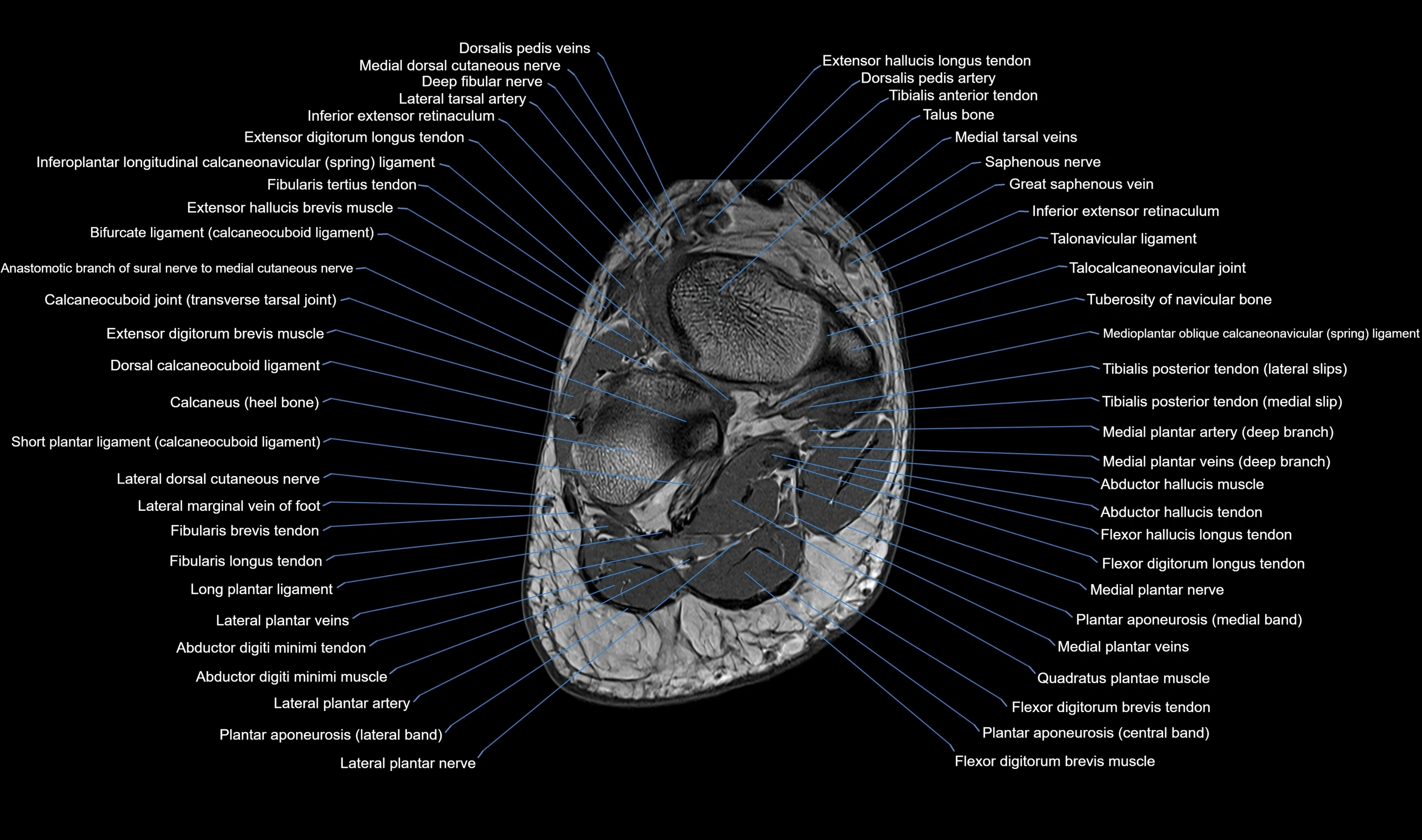 MRI mid foot axial cross sectional anatomy 3T  radiology  image-img-00001-00036.webp